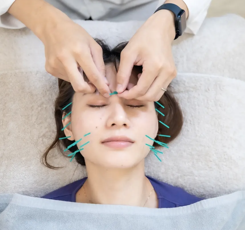 初回限定】トライアル美容鍼 60分 – SYNERGY＋